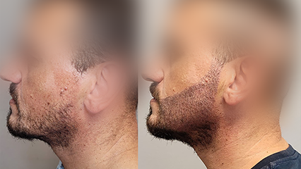 Mersin Saç Ekim - sakal-ekimi
